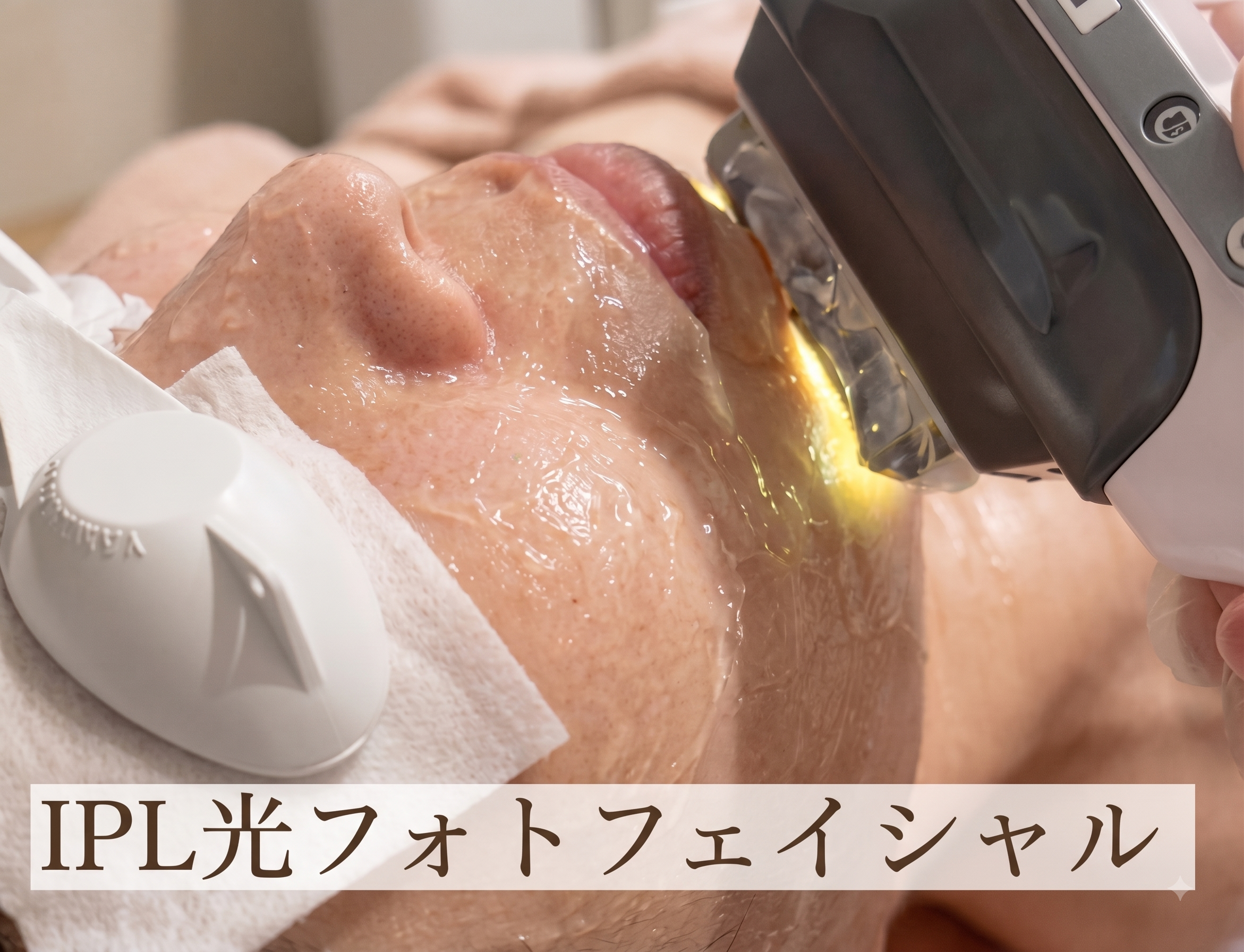 IPL光フォトフェイシャル